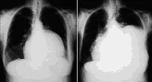 Valvulopat A Mitral Y Tric Spide Medicine