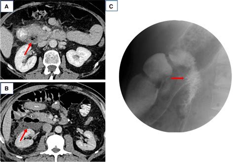 Frontiers Spontaneous Perforation Of A Primary Duodenal Diverticulum