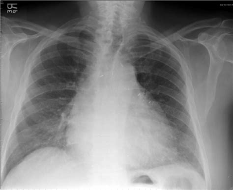 Postero Anterior Chest Radiograph Showing Cardiomegaly And No Lung