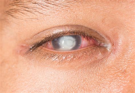 Corneal Ulcer Causes Symptoms And Treatment Eye Concepts