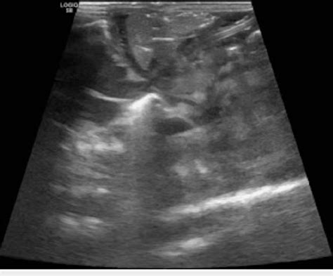 Abdominal Ultrasound Showing Umbilical Venous Catheter Uvc Entering