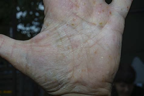 Pustular Psoriasis Lesions On The Left Palm Palmoplantar Psoriasis Stock Image Image Of