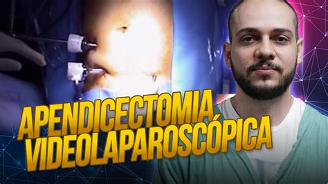 Cirurgia De Apendicite Por Videolaparoscopia Dr Thiago Analisa Passo