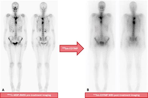 Theranostics In Nuclear Medicine Emerging And Re Emerging Integrated Imaging And Therapies In