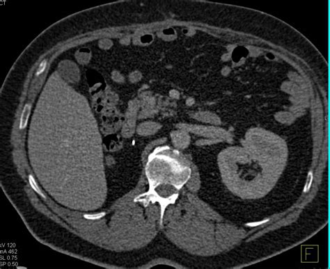 Recurrent Renal Cell Carcinoma With Metastases To Pancreas And Bone