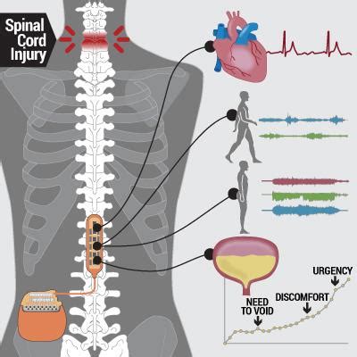 Epidural Stimulation Of The Cervical Spinal Cord For, 55% OFF