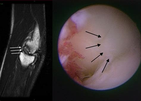 Figure From Cylindrical Costal Osteochondral Autograft For