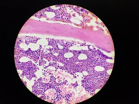 Bone Marrow Core Biopsy Pathology Disseminated Histoplasma Infection