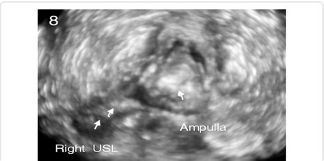 3d Ultrasound View Across The Ampulla With A Thick Right Uterosacral