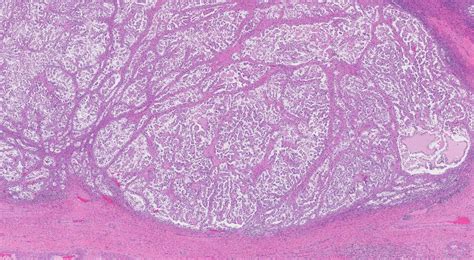 Clear Cell Carcinoma Of The Ovary Ottawa Atlas Of Pathology