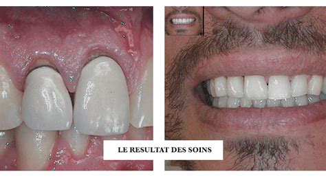 Couronne Dentaire En C Ramique Dentiste Paris J R Me Weinman