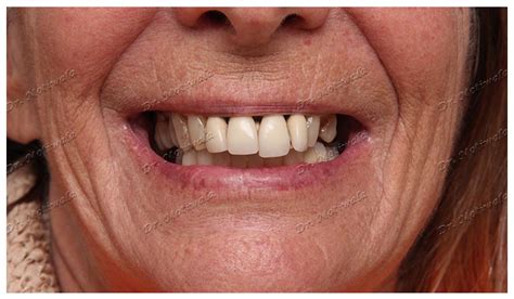 Full Mouth Dental Implants Before And After Dental Clinic