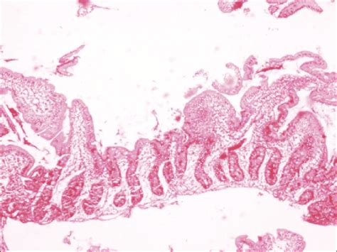 Duodenal Biopsy Showing Shortening And Flattening Of Villi H And E ×