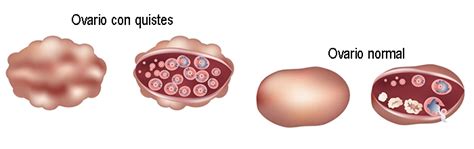 Isabel Rangel Barón Quistes En Los Ovarios Síntomas Causas Y Tratamiento