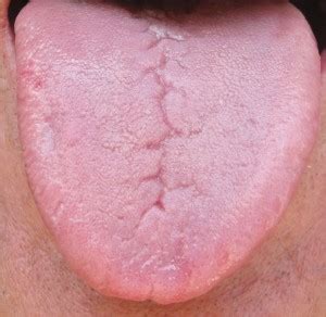 Treating And Beating Geographic Tongue And Other Tongue Problems