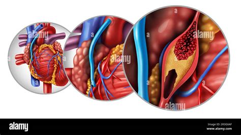 Cirug A De Bypass E Injerto De La Arteria Coronaria O Cabg Como