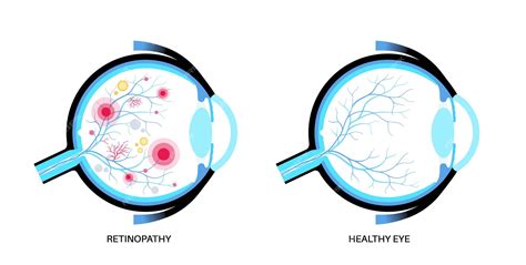 Premium Vector Diabetes Related Retinopathy