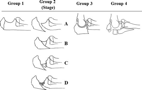 Olecranon Fracture Classification