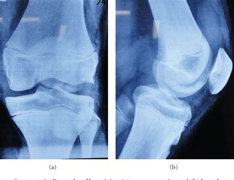 Figure 1 From Osteochondral Fracture Lateral Femoral Condyle Treated