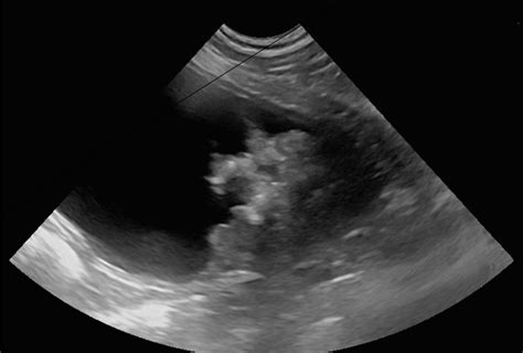 BRAF Mutation In Canine Transitional Cell And Prostate Carcinoma