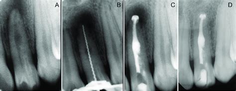 A Initial X Ray B Working Length X Ray Determination C Mta Apical