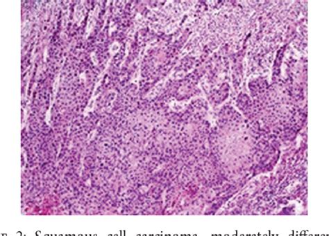 Figure 2 From Appendix And Uterus Metastasis Of Squamous Cell Carcinoma