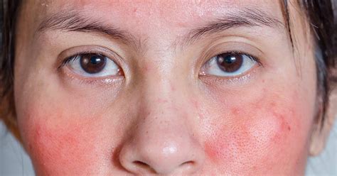 How To Treat Retinol Burn And What To Do If You Have It