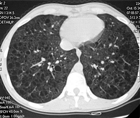 Figure 1 From Pulmonary Lymphangioleiomyomatosis As An Uncommon Cause