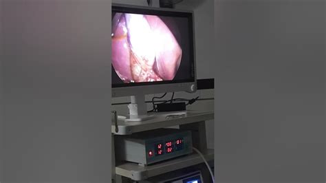 Laparoscopic Cholecystectomy Zara Youtube