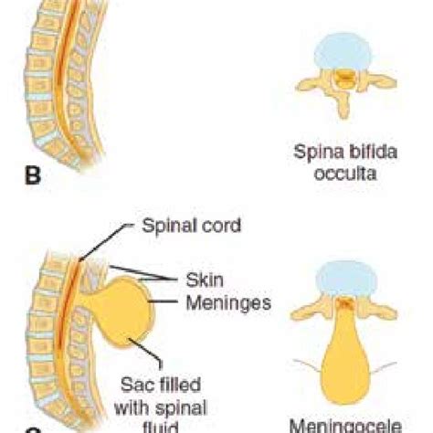 Types Of Spina Bifida A Normal Anatomical Structures B Spina