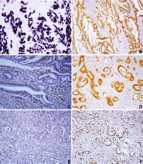 A In Situ Hybridisation Of Epsteinbarr Virus Encoded Small Rnas And Download Scientific