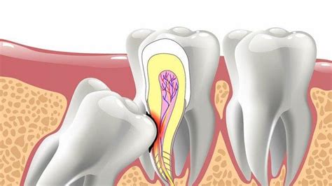 Apakah Gigi Impaksi Yang Tak Segera Diatasi Bisa Sebabkan Rahang Tak