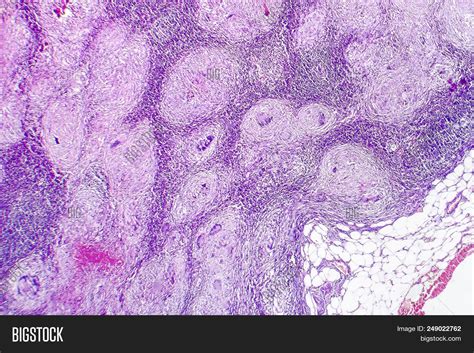 Caseous Necrosis Histology