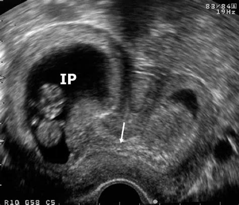 Catch Me If You Scan Ultrasound Diagnosis Of Ectopic Pregnancy