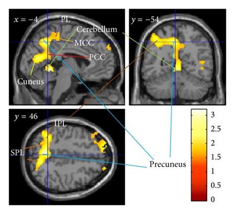 Effect Of Fsnc Training On Resting Rcbf The Results Are Shown With P