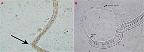 Capillaria Philippinensis Scheda Parassitologica E Approfondimenti