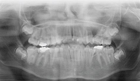 Postoperative 6 Month Follow Up Download Scientific Diagram