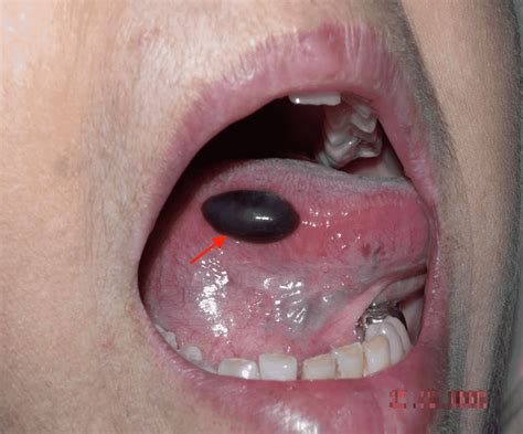 Blood Blister in Mouth Causes: Uncovering Common Triggers and Remedies - Flash Uganda Media