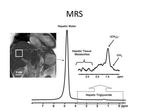 PPT - “MRI and liver fibrosis ” APASL Consensus Meeting for Liver ...