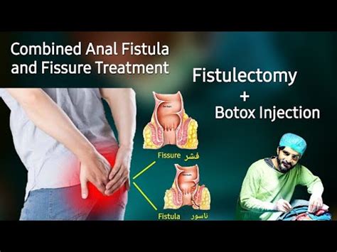 Fistulectomy For Fistula In Ano Botox For Anal Fissure Dr Tayyab