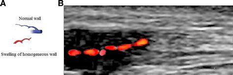 Ultrasound Image Of The Temporal Artery Wall A Pictorial Presentation Download Scientific