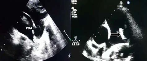 Large PDA and a fixed structure on the wall of the pulmonary artery ...