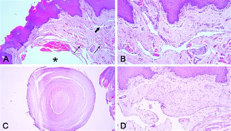 A Photomicrography Showing A Subepithelial Dilated Venous Lumen With