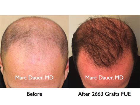 Fue In A Norwood 6 Patient Marc Dauer Md Hair Transplant Doctor Los