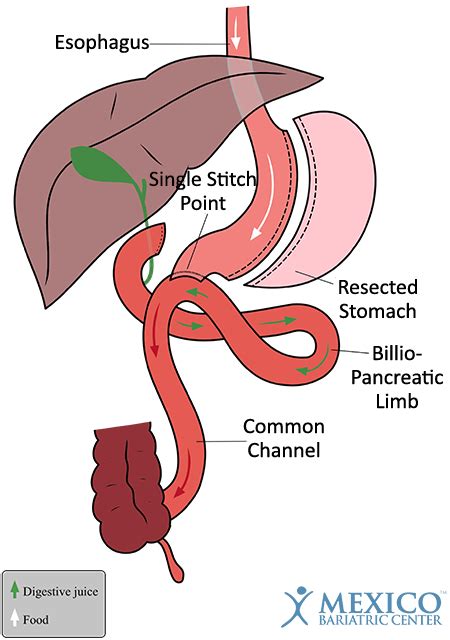 Single Anastomosis Duodenal Switch Obesity Reporter