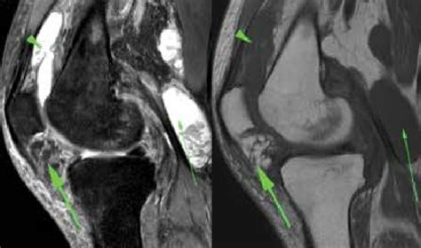 A B Sagittal T Weighted Fat Suppressed A And T Weighted B Mri