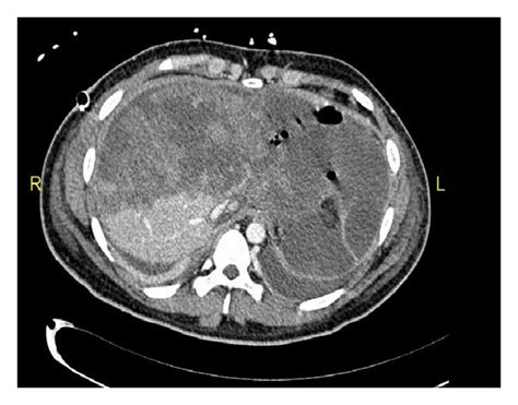 A Admission Iv Contrasts Abdomen Ct Scan Showing Extensive Liver