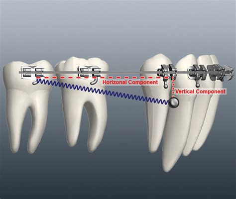 Anchorage In Orthodontics Best Orthodontist Near Me