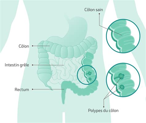 Cancer Colorectal I Msd Sant Suisse