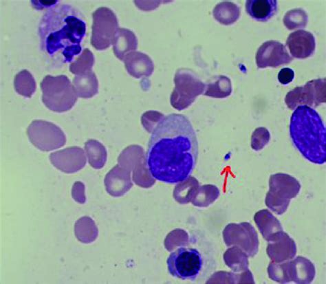 Leishman Donovan Body In Bone Marrow Smear The Red Arrow Indicates